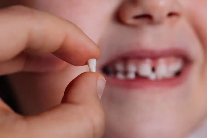 Sơ đồ răng sữa: 20 răng, lịch mọc và lịch thay